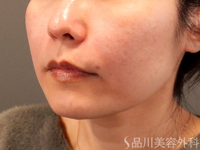 症例NO.69798のAFTER写真