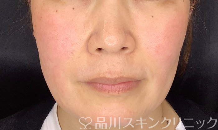 症例NO.74967のAFTER写真