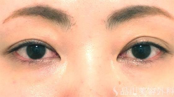症例NO.27046のBEFORE写真