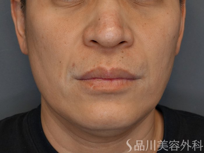 症例NO.73048のBEFORE写真