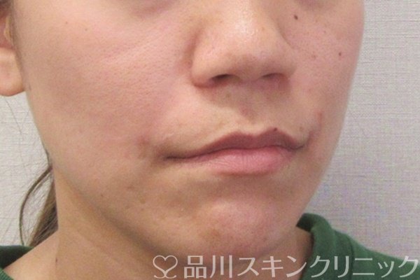 症例NO.70203のAFTER写真