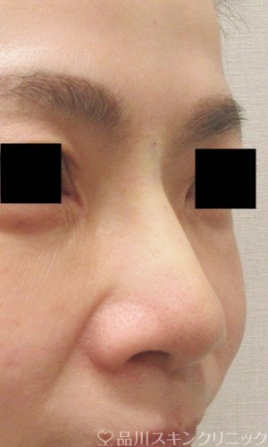 症例NO.69373のAFTER写真