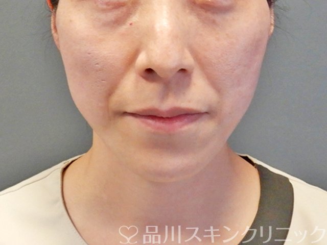 症例NO.68460のAFTER写真