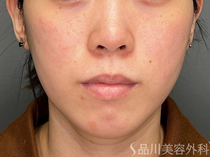 症例NO.74385のBEFORE写真