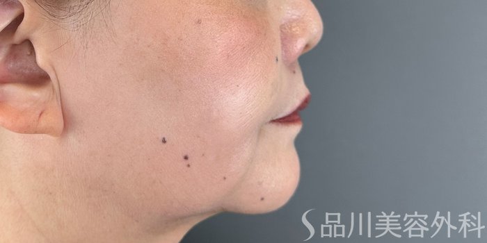 症例NO.71783のAFTER写真