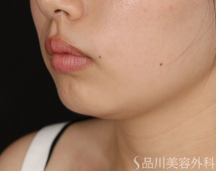 症例NO.71127のBEFORE写真