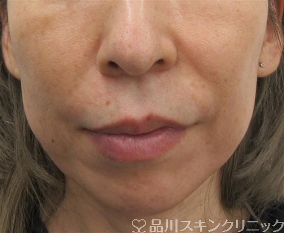 症例NO.54275のBEFORE写真
