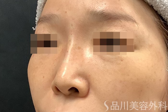 症例NO.71256のAFTER写真