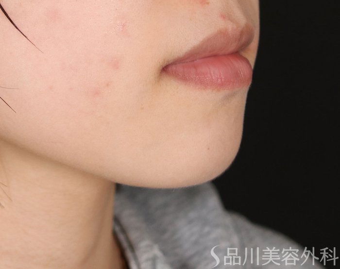 症例NO.74007のBEFORE写真