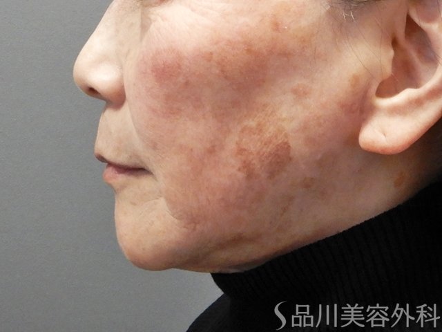 症例NO.70431のBEFORE写真