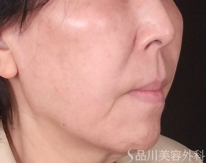 症例NO.69631のBEFORE写真