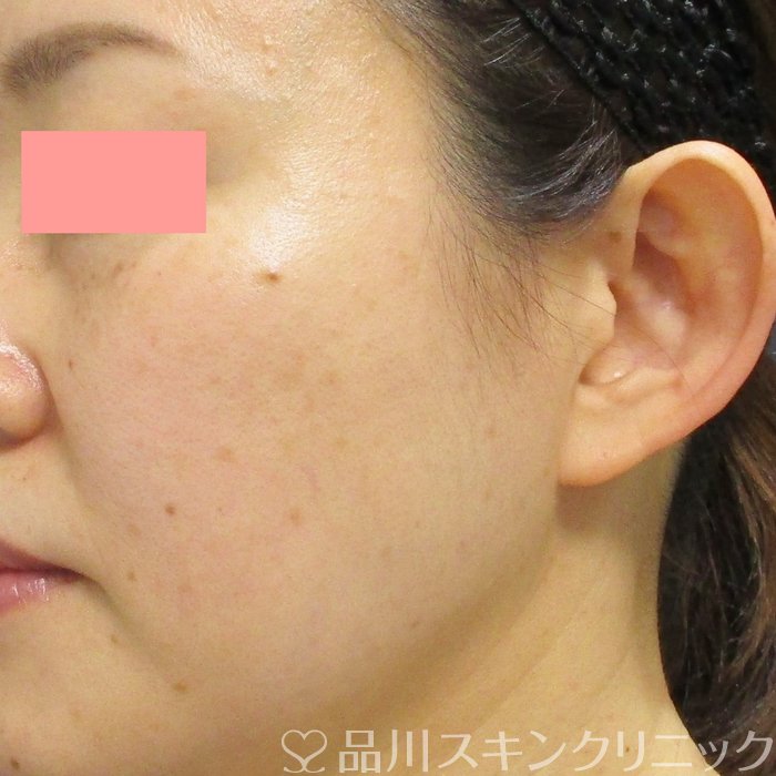 症例NO.70971のAFTER写真