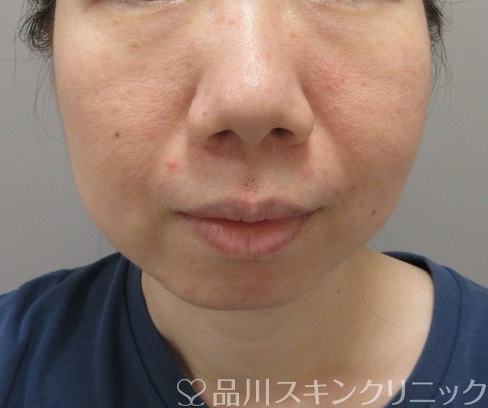 症例NO.73091のBEFORE写真