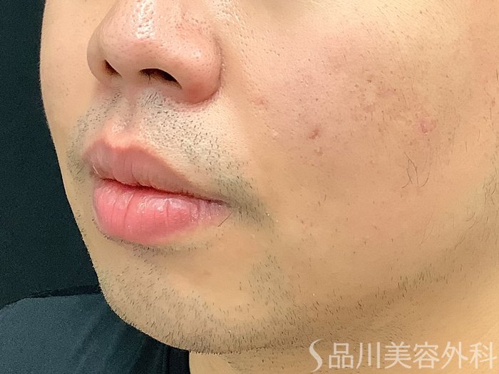 症例NO.67909のBEFORE写真