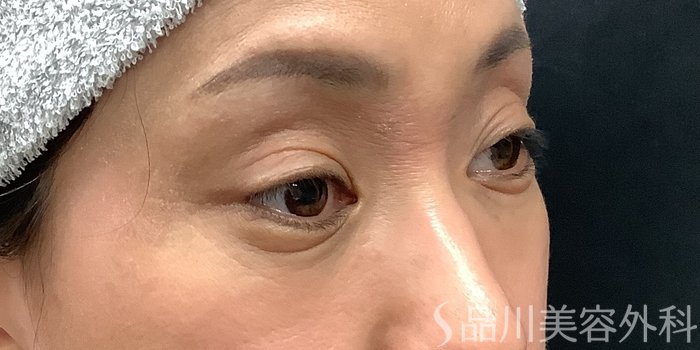 症例NO.65225のBEFORE写真