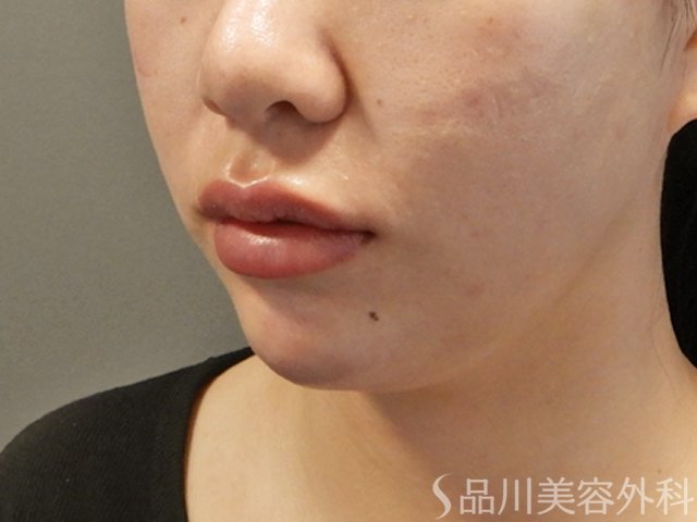 症例NO.71551のAFTER写真
