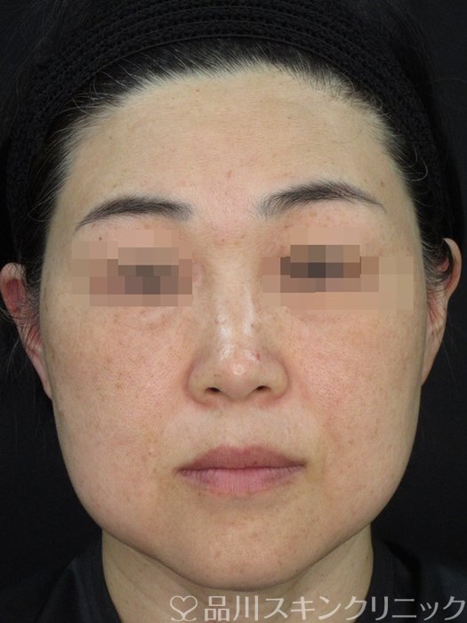 症例NO.72851のBEFORE写真