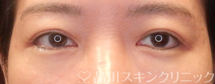 症例NO.67862のAFTER写真