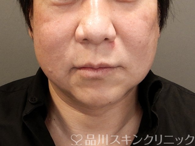 症例NO.68572のAFTER写真