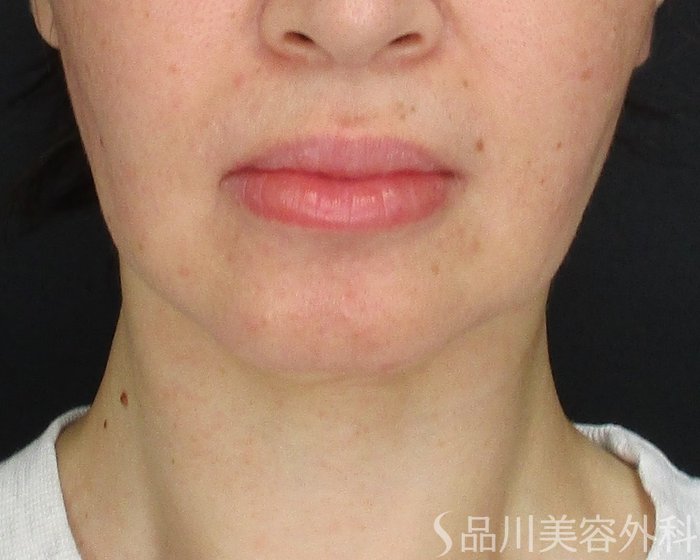 症例NO.74805のBEFORE写真