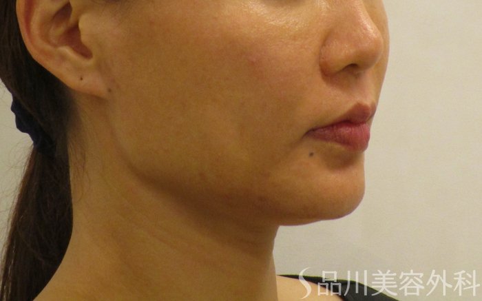 症例NO.62386のBEFORE写真
