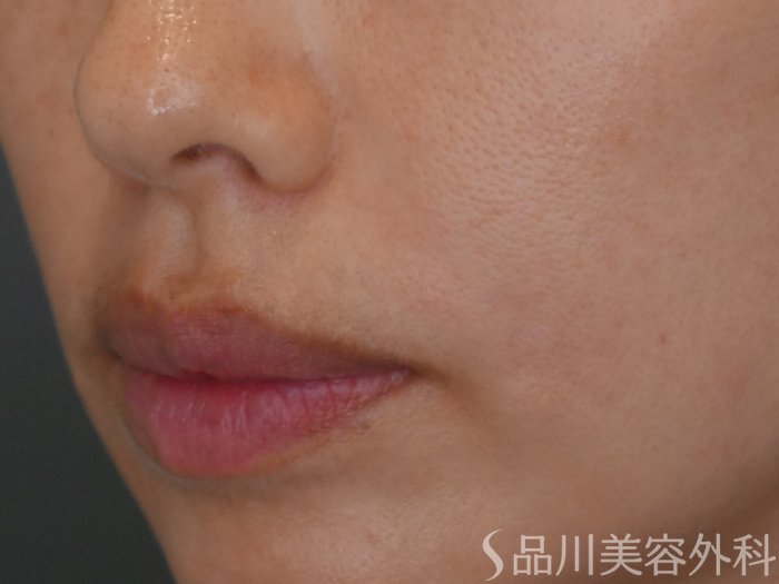 症例NO.67168のAFTER写真