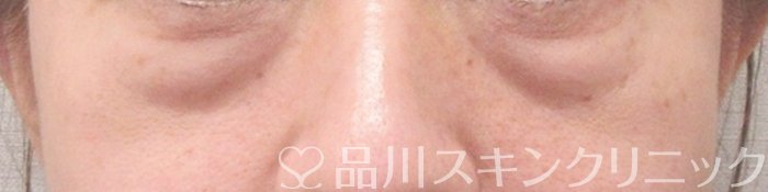 症例NO.70461のBEFORE写真