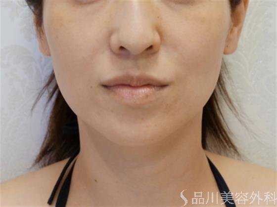 症例NO.36371のBEFORE写真