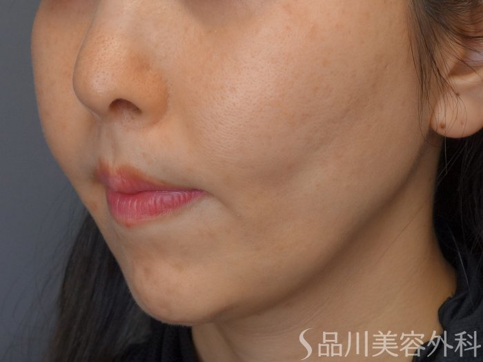 症例NO.73030のBEFORE写真