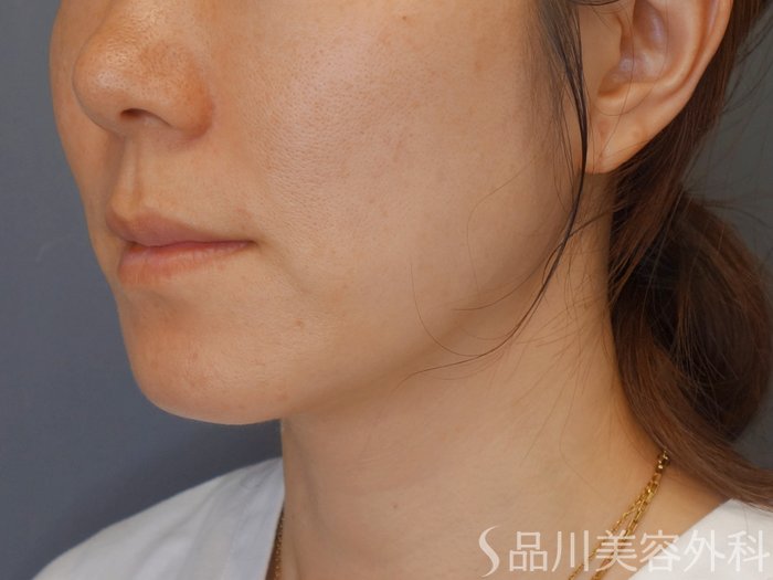 症例NO.72078のBEFORE写真