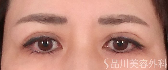症例NO.70078のAFTER写真