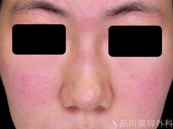 症例NO.47387のBEFORE写真