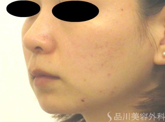 症例NO.40811のAFTER写真