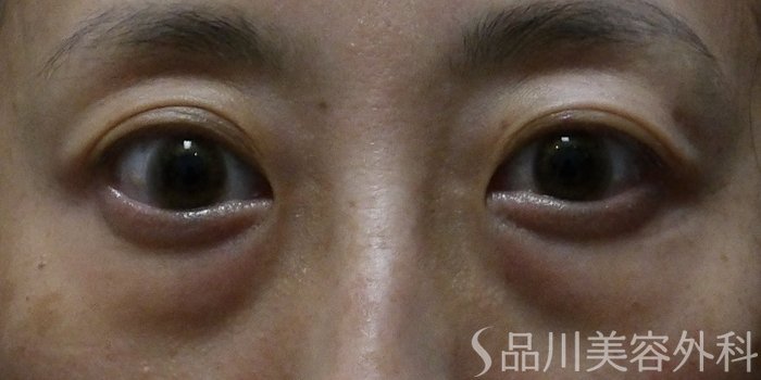 症例NO.70704のBEFORE写真
