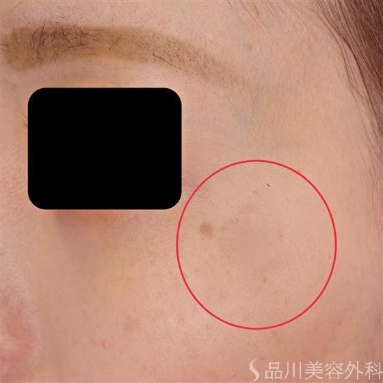 症例NO.53509のAFTER写真