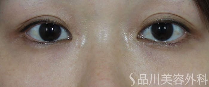 症例NO.72508のBEFORE写真