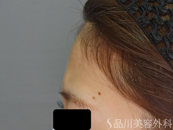 症例NO.70716のBEFORE写真