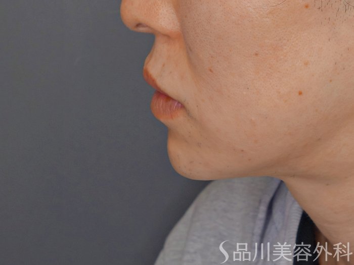 症例NO.72866のAFTER写真