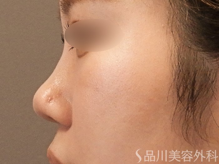 症例NO.71019のAFTER写真