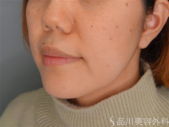 症例NO.54016のBEFORE写真