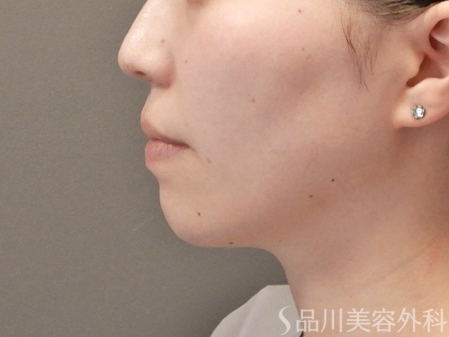 症例NO.75130のBEFORE写真