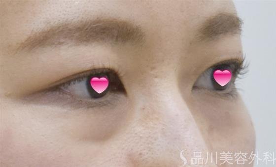 症例NO.52437のBEFORE写真