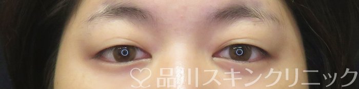 症例NO.62906のBEFORE写真