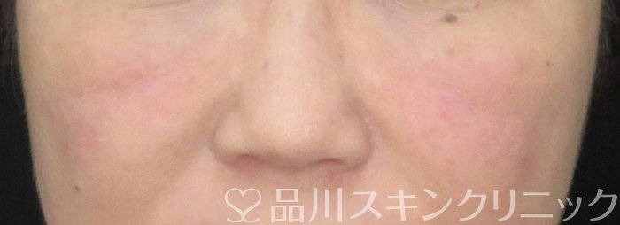 症例NO.65704のAFTER写真