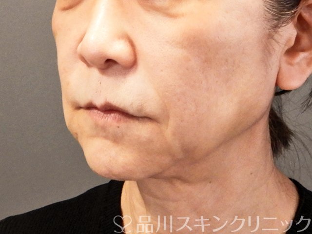 症例NO.68573のBEFORE写真