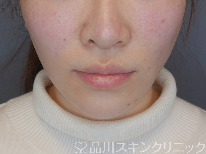 症例NO.72578のAFTER写真