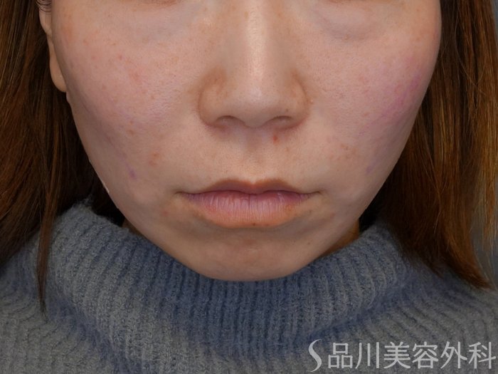 症例NO.74068のAFTER写真