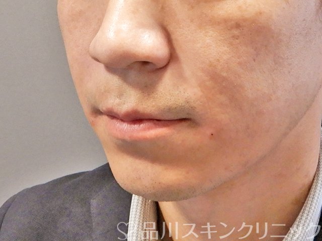症例NO.68334のAFTER写真