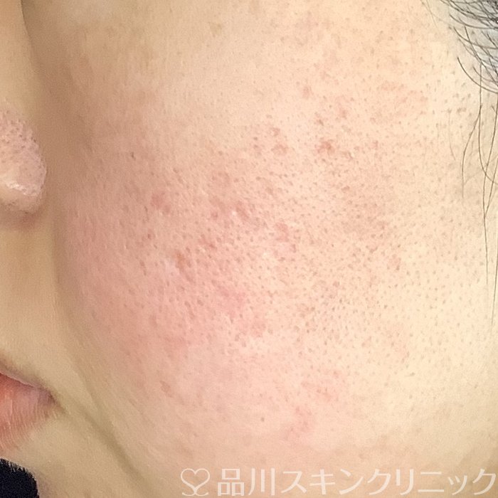 症例NO.65631のBEFORE写真