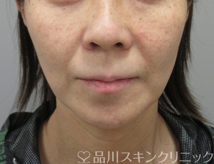 症例NO.73600のAFTER写真